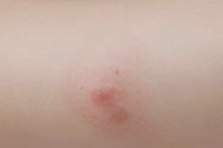 孩子屁股上出湿疹可以治好吗(图4)