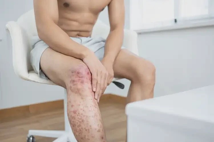 青年人大腿上出现湿疹可以治好吗(图3)