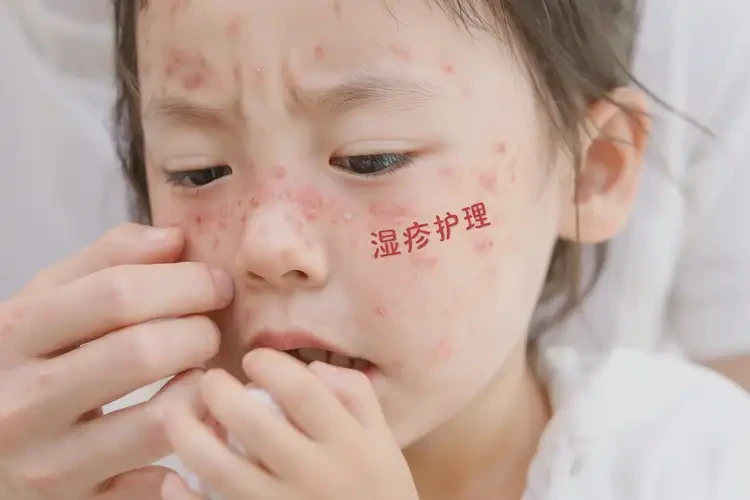 儿童脸上出现湿疹可以治好吗(图4)