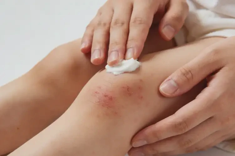 儿童大腿出湿疹可以治好吗(图1)