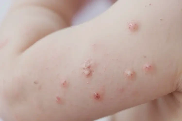 婴儿手臂上起湿疹可以治好吗(图4)