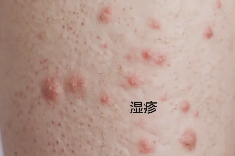 女人大腿长湿疹能不能彻底自愈(图4)