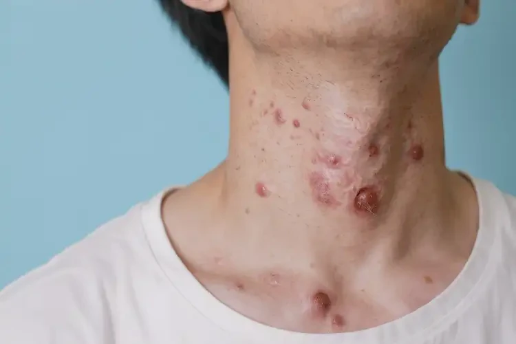 青年人脖子经常长湿疹可以治好吗(图4)