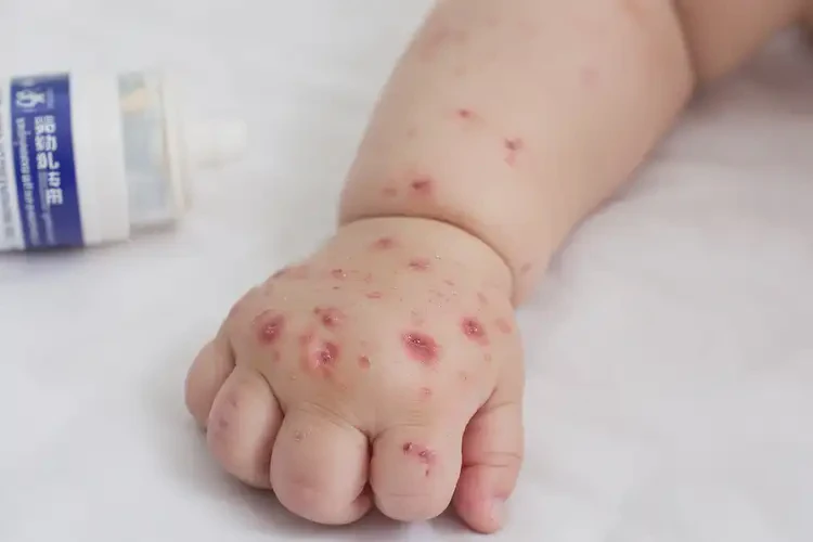 婴幼儿手上经常起湿疹能治好吗(图4)