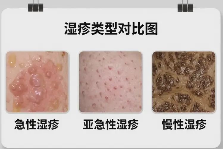 大学生身上有湿疹可以治好吗(图3)