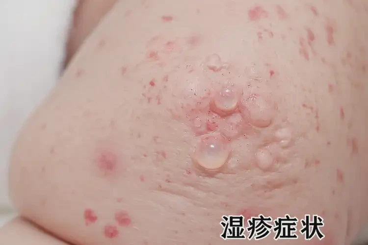 婴儿小腿上长湿疹可以治好吗(图4)