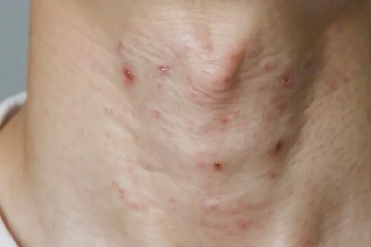 男生脖子上偶尔起湿疹可以治好吗(图4)