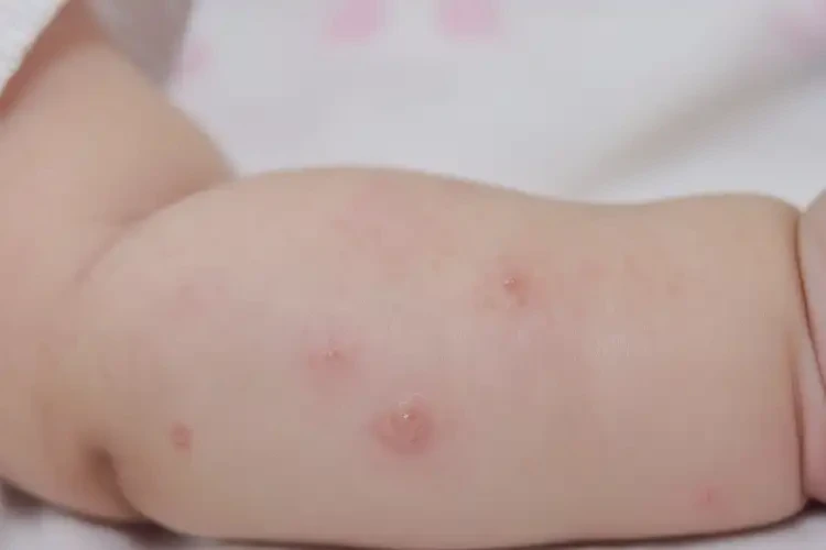 婴幼儿手臂长湿疹可以治好吗(图4)