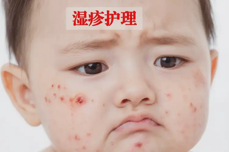 孩子脸上经常长湿疹可以治好吗(图3)