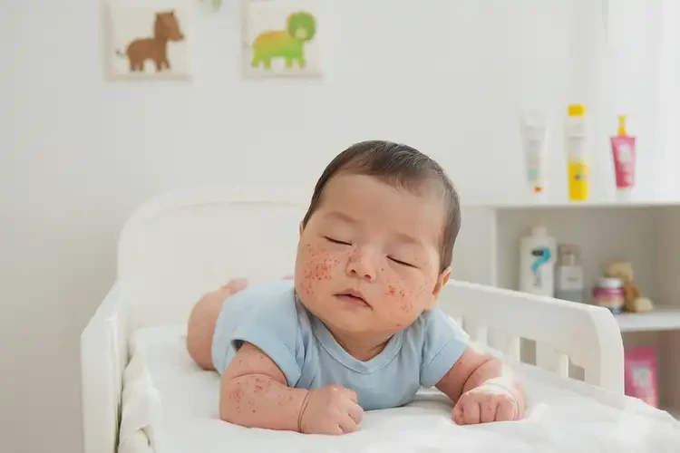 小儿身上偶尔起湿疹能靠自己自愈吗(图4)