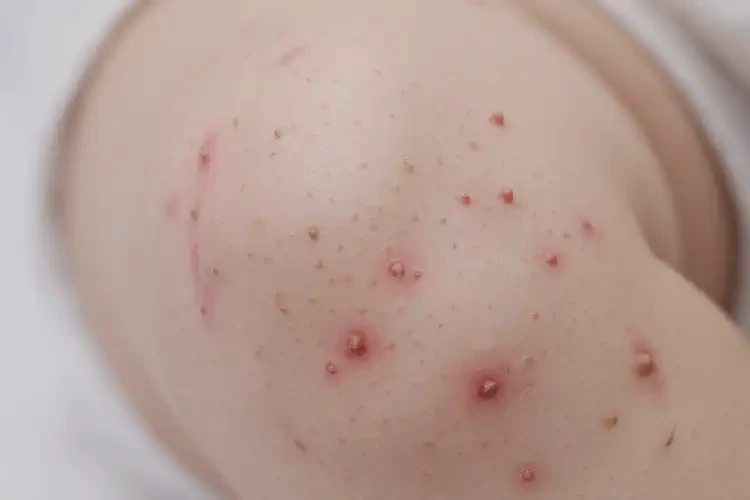 小儿大腿经常长湿疹可以治好吗(图4)