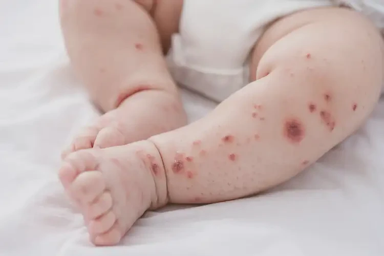 婴幼儿四肢偶尔起湿疹可以治好吗(图4)