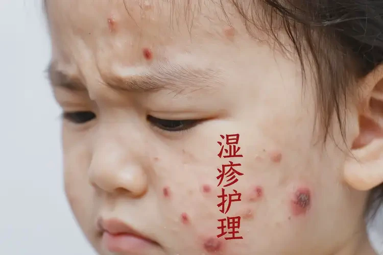 小儿脸上出湿疹可以治好吗(图4)