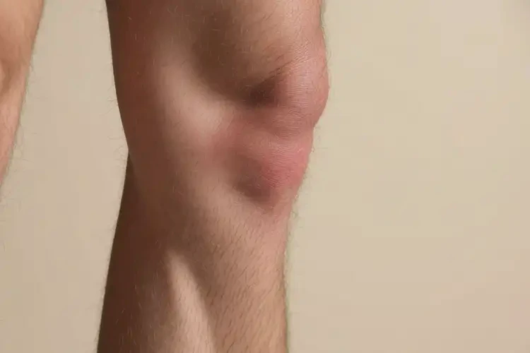 男性小腿上偶尔长湿疹可以治好吗(图4)