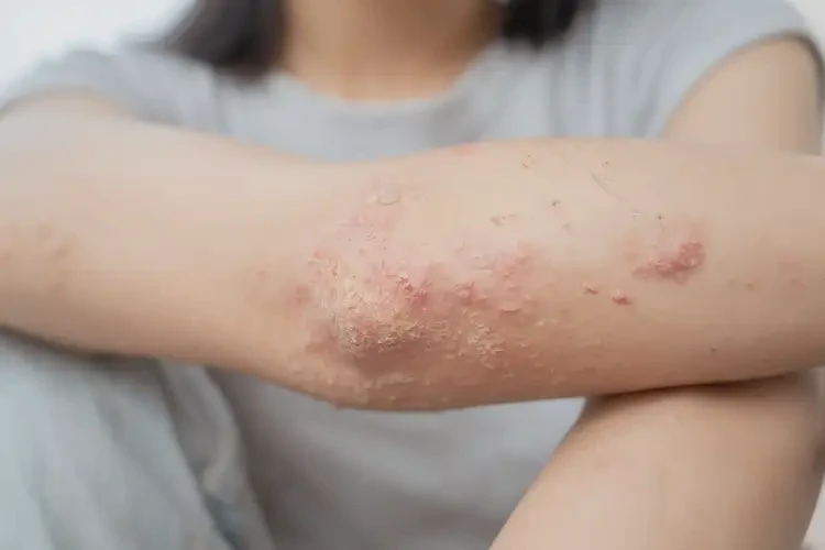 女生手臂长湿疹可以治好吗(图4)