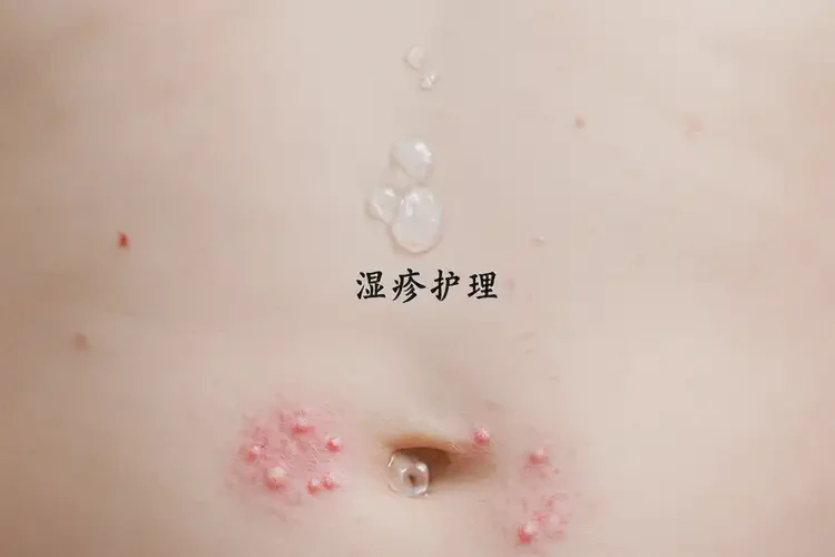 小儿肚子长湿疹可以治好吗(图4)