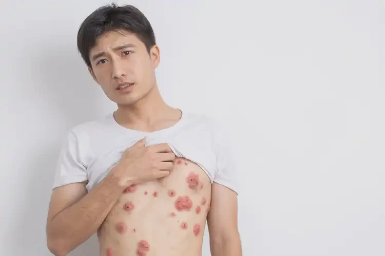 青年人肚子偶尔起湿疹可以治好吗(图4)