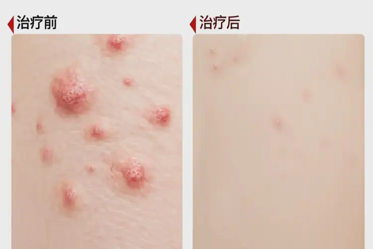 男生身上有湿疹可以治好吗(图4)