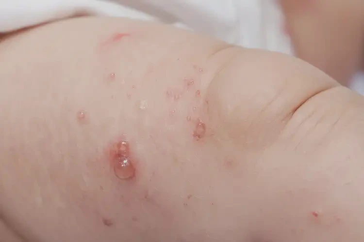 婴儿小腿上长湿疹可以治好吗(图3)