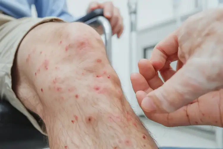 男性小腿上出湿疹可以治好吗(图4)