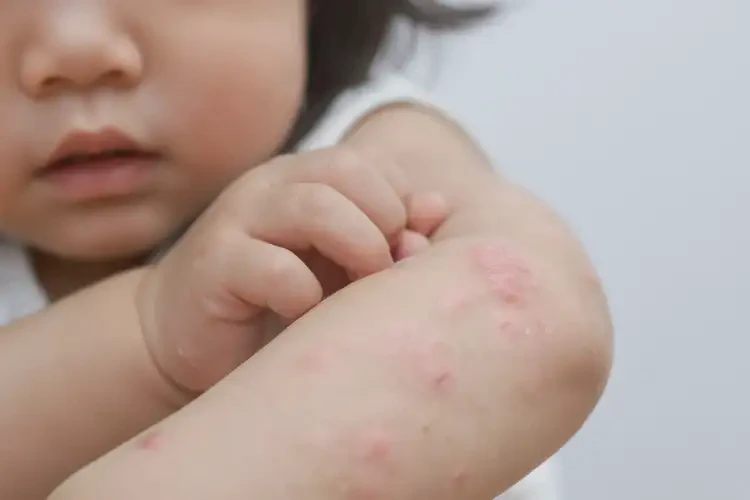 孩子全身有湿疹可以彻底自愈吗(图4)