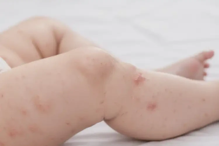 小儿大腿有湿疹可以治好吗(图4)