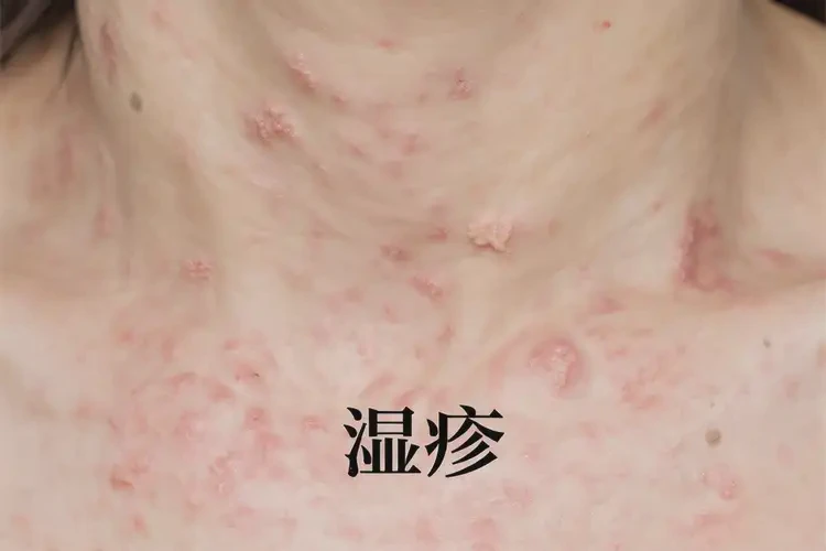 女性脖子上起湿疹可以治好吗(图4)