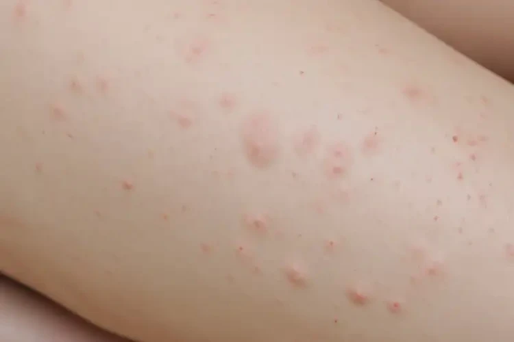 女性大腿偶尔长湿疹不管它会自己好吗(图4)